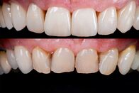 Puls – Puls Veneers, Bleaching und Co – Der hohe Preis der perfekten Zähne Gebleachte Zähne vorher und nachher Copyright: SRF