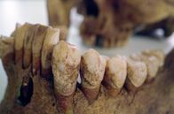 Das Steinzeit-Menü – Ein menschlicher Kiefer mit fossilisiertem Zahnstein
