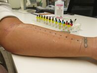 Servus Reportage – Allergologe - Allergietest