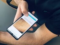 Servus Reportage – App für die Hautkrebserkennung