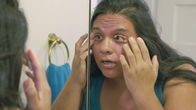 Dr. Pimple Popper – Hilda, who suffers from ulcers around the eyes.