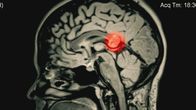 Wunder der Wissenschaft – Kopfschmerzen, Erschöpfung, Konzentrationsschwächen - kein Müdigkeitssyndrom, aber ein ungeborener Zwilling im Kopf.