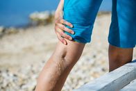Visite – Woman touching painful varicose veins on a leg