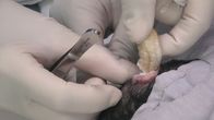 Dr. Pimple Popper – During surgery.