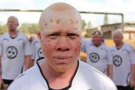 9 Monate - Ein Leben beginnt – Nasoro, ein Mitglied des Albino-United-Football-Teams.