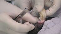 Dr. Pimple Popper – During surgery.