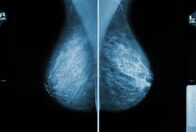 Visite (MDR) – Mammogram images showing breast tissue for medical examination and diagnosis purposes. X-ray mlo mammography for breast cancer, checking breasts.