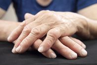 Doc Fischer – "Hand einer an rheumatoider Arthritis deformierten Frau"