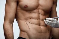 Make me beautiful – Männliche Körperchirurgie; Nahaufnahme des fitten Oberkörpers eines jungen Mannes mit chirurgischen Linien.