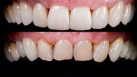 Puls – Puls Veneers, Bleaching und Co – Der hohe Preis der perfekten Zähne Gebleachte Zähne vorher und nachher Copyright: SRF